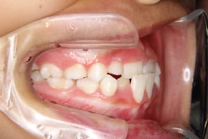 中切歯が逆被蓋になっています